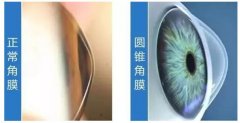 配了眼镜也看不清?有可能是因为这种